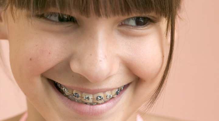 Çocuklarda ortodonti tedavisi için geç kalmayın!