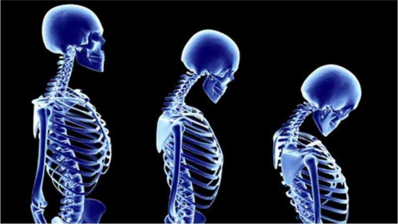 OSTEOPOROZA KARŞI ÖNLEMİNİZİ ALIN