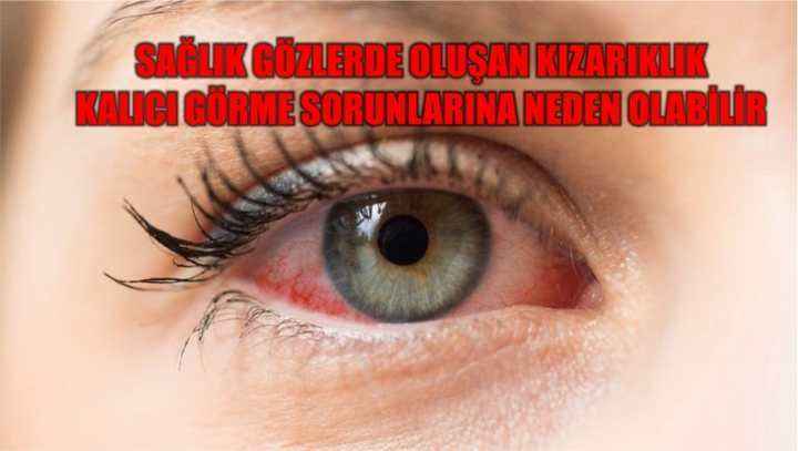 Sağlık Gözlerde oluşan kızarıklık kalıcı görme sorunlarına neden olabilir