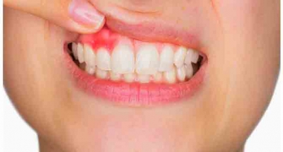 Diş Etinde Kırmızılık ve Şişkinliğe Dikkat !