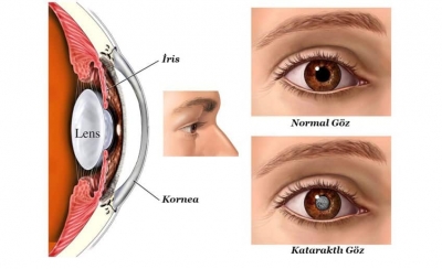 İlerleyen Yaş Gözler de Katarakta Sebep Oluyor !