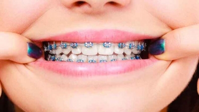 Ortodonti Tedavisinde Evde Acil Müdahaleler Nasıl Yapılır?