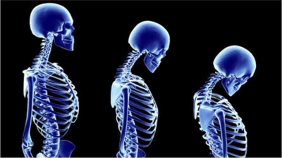 OSTEOPOROZA KARŞI ÖNLEMİNİZİ ALIN